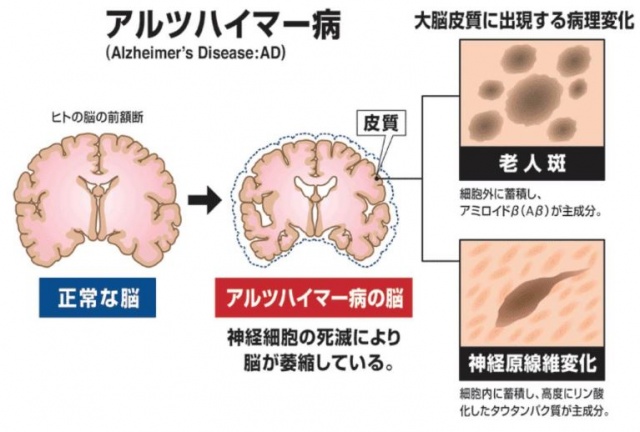 認知症予備軍が血液検査でわかる時代が く る